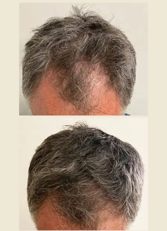 Clinique SkinIn HAIRestart® Stimulation de la croissance capillaire ​