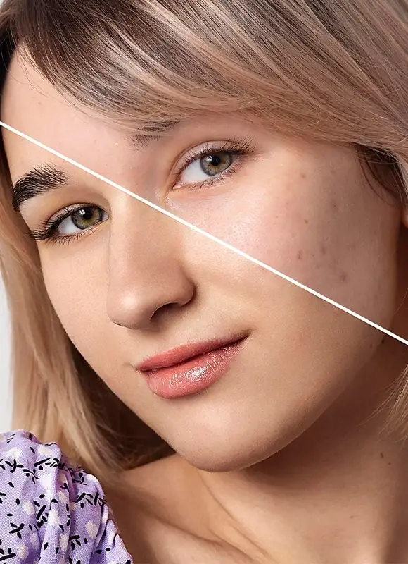Clinique SkinIn Acné et révision des cicatrices d'acné​