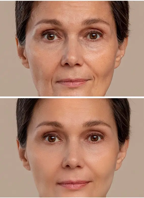 Clinique SkinIn Lifting non-invasif 4D Rajeunissement de la peau​